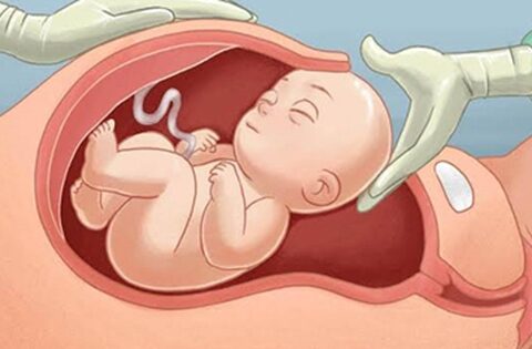 Yếu tố hình thành nhau cài răng lược – mối nguy hiểm trong thai kỳ