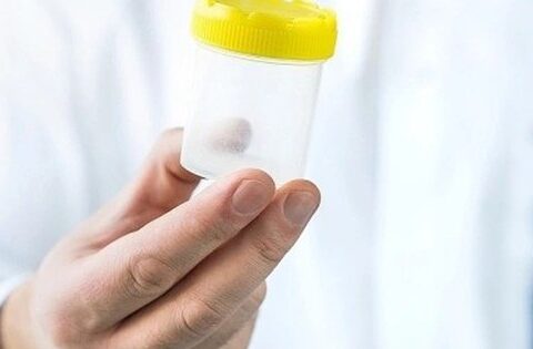 Tinh dịch đổi màu: Dấu hiệu bệnh lý không thể chủ quan