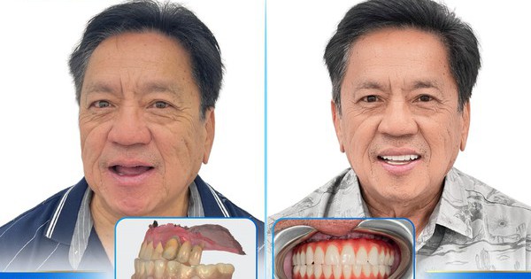 Vì sao Implant công nghệ cao trở thành lựa chọn đầu tư thông minh cho nụ cười người Việt?