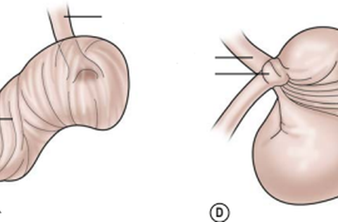 Xoắn dạ dày ở trẻ em rất nguy hiểm, cha mẹ cần phát hiện sớm