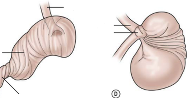 Xoắn dạ dày ở trẻ em rất nguy hiểm, cha mẹ cần phát hiện sớm