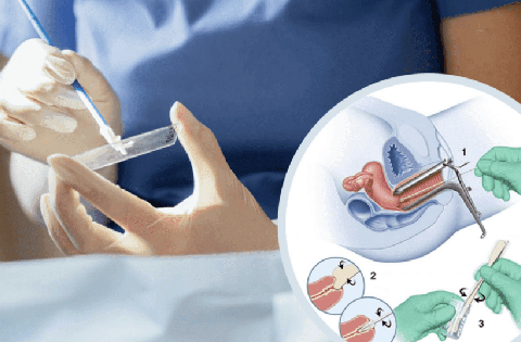 Khi nào nên xét nghiệm Pap sàng lọc ung thư cổ tử cung?