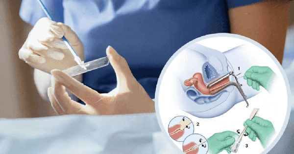 Khi nào nên xét nghiệm Pap sàng lọc ung thư cổ tử cung?