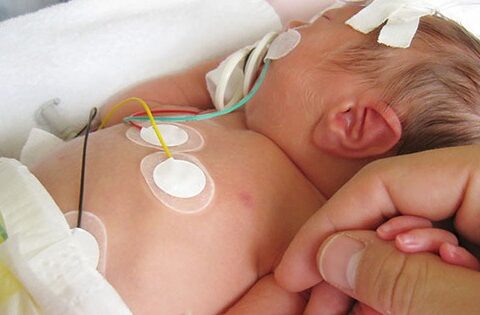 Trẻ mắc bệnh tim bẩm sinh có tím cần phát hiện và điều trị sớm