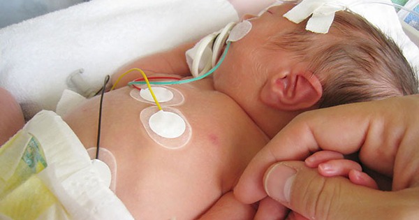 Trẻ mắc bệnh tim bẩm sinh có tím cần phát hiện và điều trị sớm