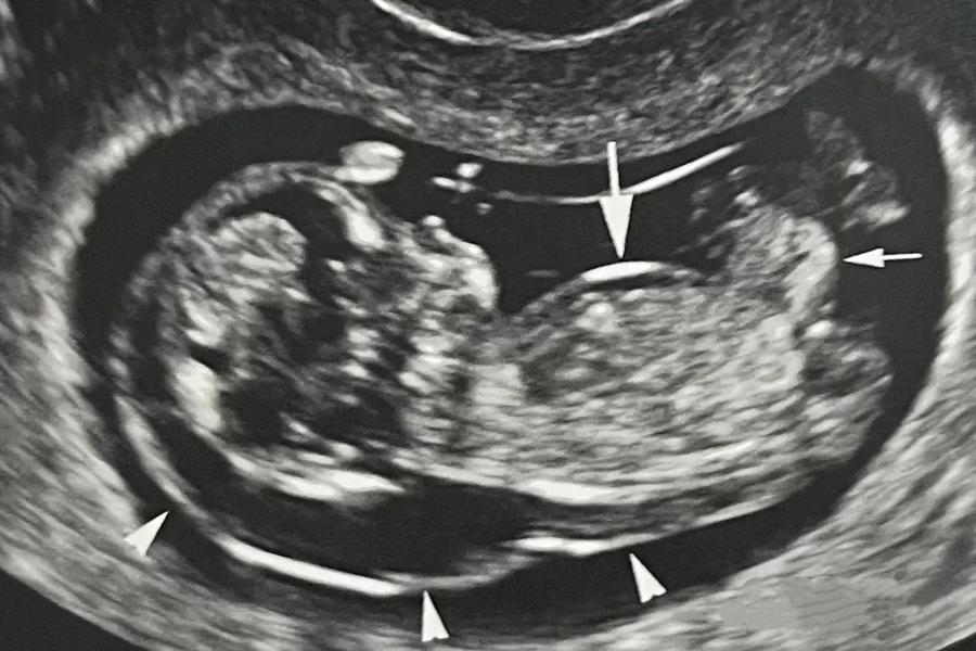 Top 4 dị tật bẩm sinh thường gặp ở trẻ sơ sinh và giải pháp phát hiện sớm từ trong bụng mẹ- Ảnh 2.