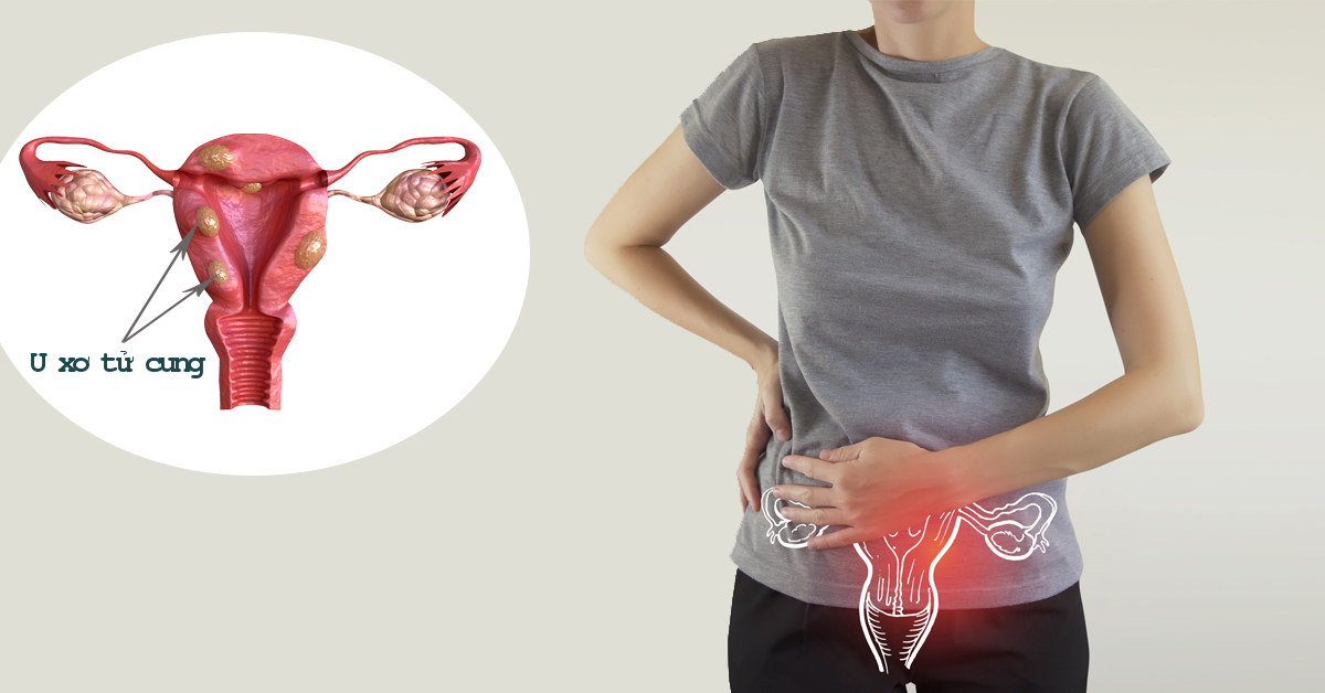 U xơ tử cung có gây hiếm muộn không?- Ảnh 1. U xơ tử cung có gây hiếm muộn không?- Ảnh 1.