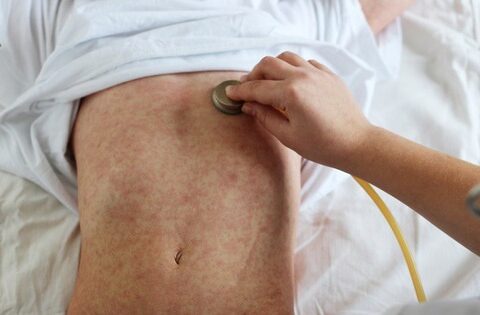 Sắp Tết, cảnh giác với bệnh sởi bùng phát ở trẻ em