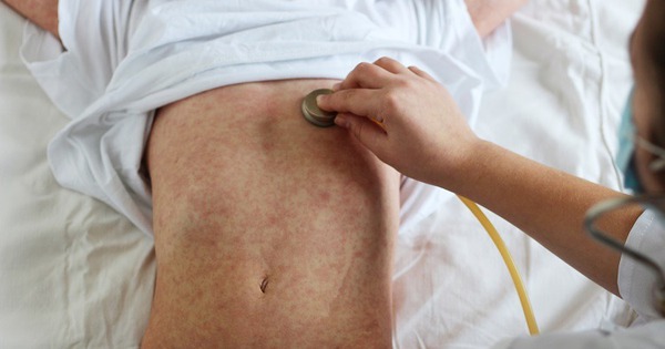 Sắp Tết, cảnh giác với bệnh sởi bùng phát ở trẻ em