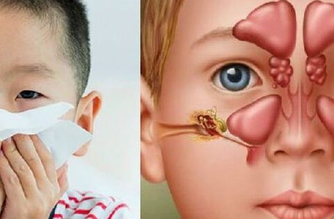 Biểu hiện thường gặp viêm mũi xoang ở trẻ