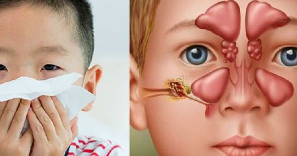 Biểu hiện thường gặp viêm mũi xoang ở trẻ