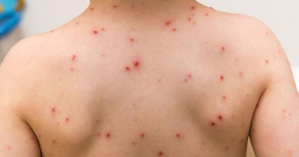 3 bệnh thường gặp ở trẻ vào mùa xuân