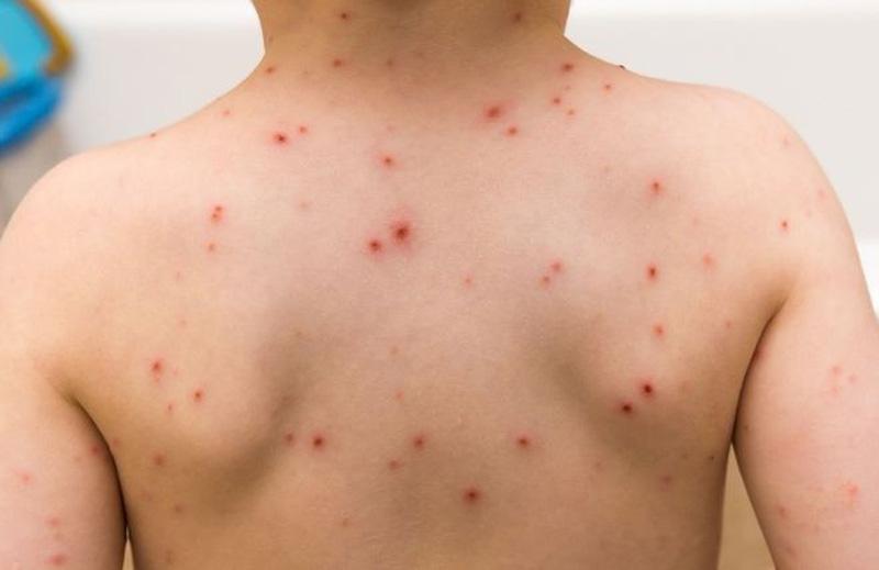 Bệnh sởi thường xuất hiện ở trẻ em nhưng người lớn cũng có thể mắc. Bệnh sởi lây lan nhanh trong cộng đồng. Ảnh minh họa Bệnh sởi thường xuất hiện ở trẻ em nhưng người lớn cũng có thể mắc. Bệnh sởi lây lan nhanh trong cộng đồng. Ảnh minh họa