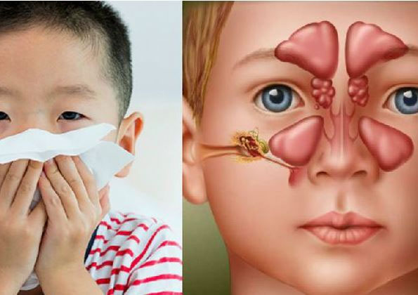 Biểu hiện thường gặp viêm mũi xoang ở trẻ- Ảnh 1. Viêm xoang ở trẻ em: Nguyên nhân, triệu chứng và cách điều trị