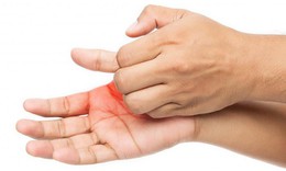 Tay lạnh trong mùa lạnh là bệnh gì, nguy hiểm không? 