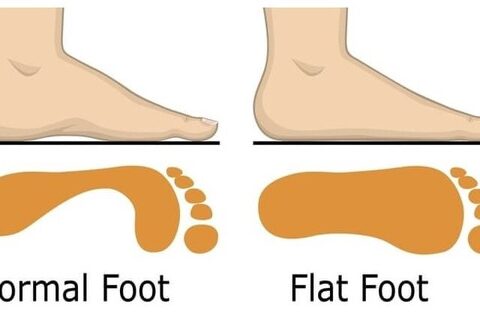 Bàn chân bẹt ở trẻ em có cần điều trị không?