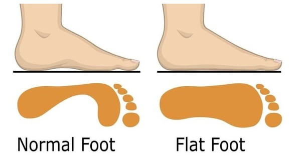 Bàn chân bẹt ở trẻ em có cần điều trị không?