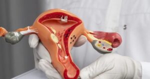 Tắc vòi trứng gây cản trở khả năng thụ thai tự nhiên