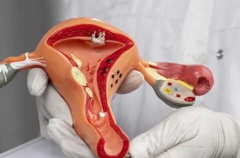 Tắc vòi trứng gây cản trở khả năng thụ thai tự nhiên