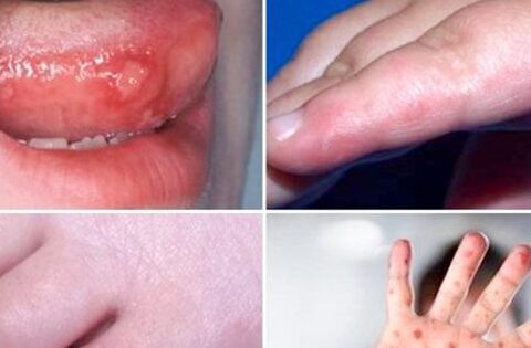 dấu hiệu bệnh tay chân miệng nặng