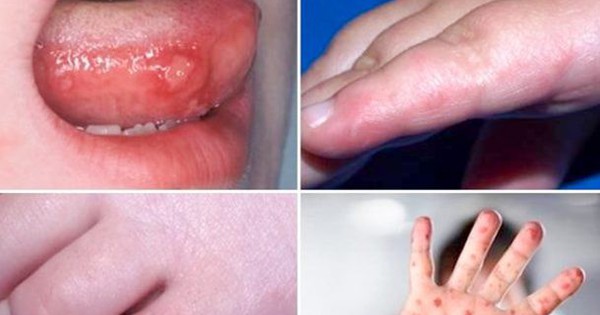 dấu hiệu bệnh tay chân miệng nặng
