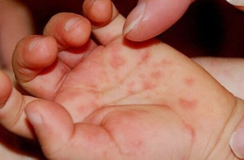Bệnh tay chân miệng: khi nào chăm sóc trẻ tại nhà, khi nào cần đến viện gấp?
