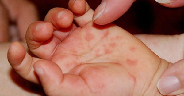 Bệnh tay chân miệng: khi nào chăm sóc trẻ tại nhà, khi nào cần đến viện gấp?