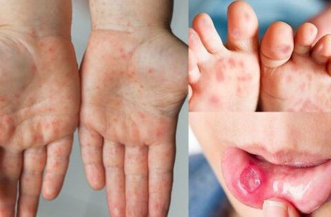 4 trẻ tử vong do tay chân miệng, cách giác những biểu hiện không điển hình