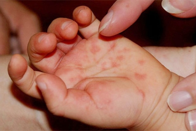 Bệnh tay chân miệng: khi nào chăm sóc trẻ tại nhà, khi nào cần đến viện gấp?- Ảnh 1. Bệnh tay chân miệng: khi nào chăm sóc trẻ tại nhà, khi nào cần đến viện gấp?- Ảnh 1.