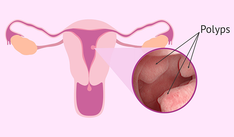 Dấu hiệu cảnh báo polyp nội mạc tử cung cần đi khám- Ảnh 1.