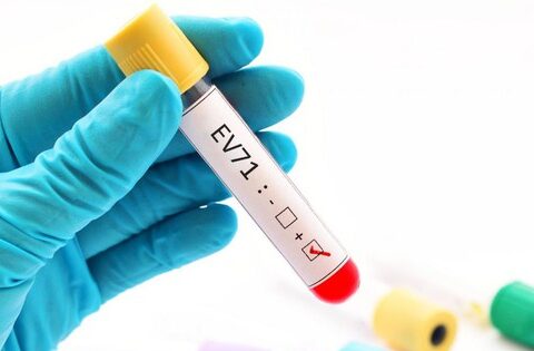 Trẻ mắc tay chân miệng do EV71 dễ chuyển nặng, khả năng tồn tại và lây lan của virus