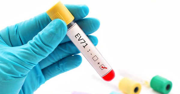 Trẻ mắc tay chân miệng do EV71 dễ chuyển nặng, khả năng tồn tại và lây lan của virus