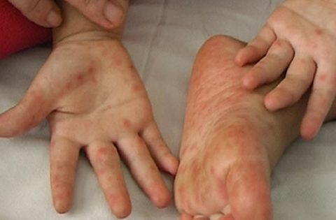 Thời gian lây bệnh tay chân miệng kéo dài bao lâu?