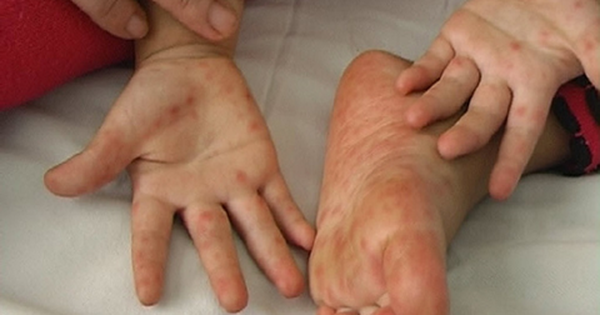 Thời gian lây bệnh tay chân miệng kéo dài bao lâu?