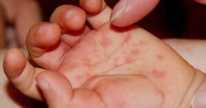 Cha mẹ cần làm gì khi tay chân miệng lây lan trong trường học?