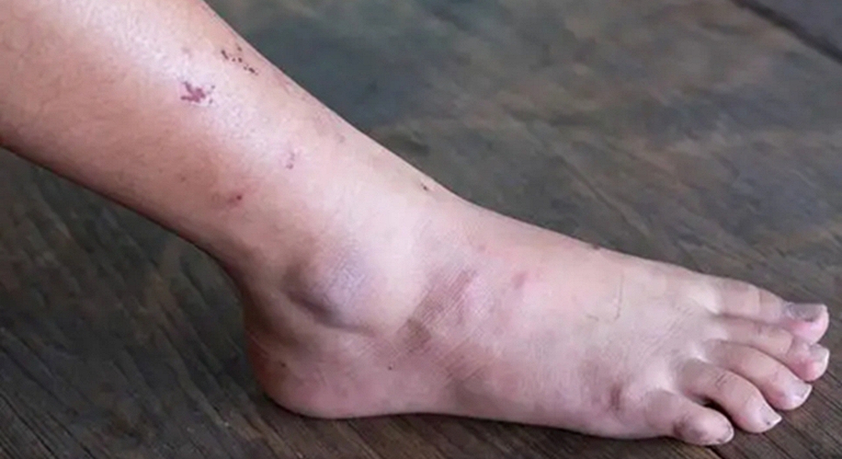 Khi ung thư mới bắt đầu hình thành, người ta thường cảm thấy 3 điều không ổn, nhưng ít ai chú ý đến