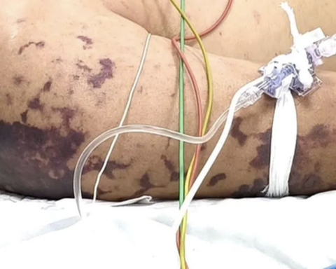 4 ca tử vong do não mô cầu, Bộ Y tế cảnh báo nguy cơ