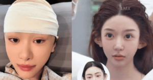 Tất tần tật về xu hướng “cao hộp sọ” ở Trung Quốc: Hậu quả sau màn bơm “xi măng xương”, tiêm chất làm đầy lên da đầu