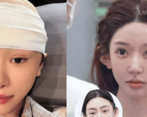 Tất tần tật về xu hướng “cao hộp sọ” ở Trung Quốc: Hậu quả sau màn bơm “xi măng xương”, tiêm chất làm đầy lên da đầu