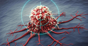 Dấu hiệu cảnh báo ung thư trước 1 năm