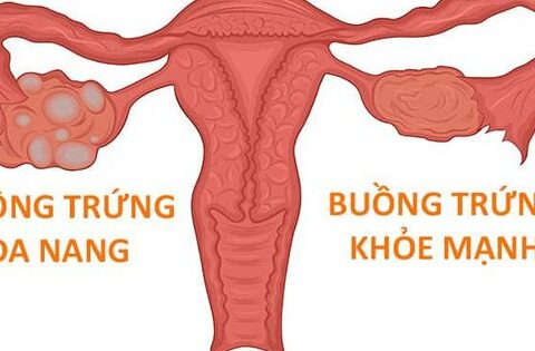 Phụ nữ mắc hội chứng buồng trứng đa nang có mang thai được không?