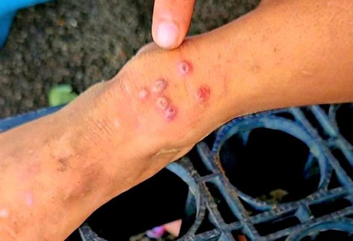 Thái Lan bật cảnh báo khi 23 người tử vong, 732 người bị lây nhiễm 1 căn bệnh, ở Việt Nam cũng đã xuất hiện