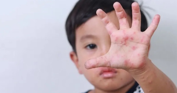 Cảnh báo bệnh tay chân miệng tăng mạnh ở trẻ mầm non