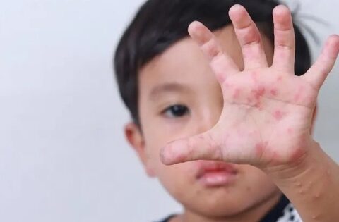 Cảnh báo bệnh tay chân miệng tăng mạnh ở trẻ mầm non
