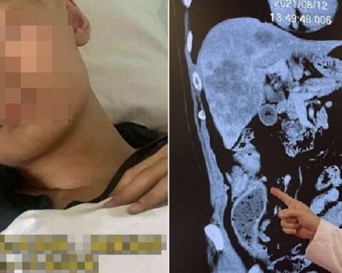 Thiếu niên 18 tuổi mắc ung thư đại trực tràng giai đoạn 3, bác sĩ nhắc: Người trẻ thường bỏ qua 2 dấu hiệu cảnh báo