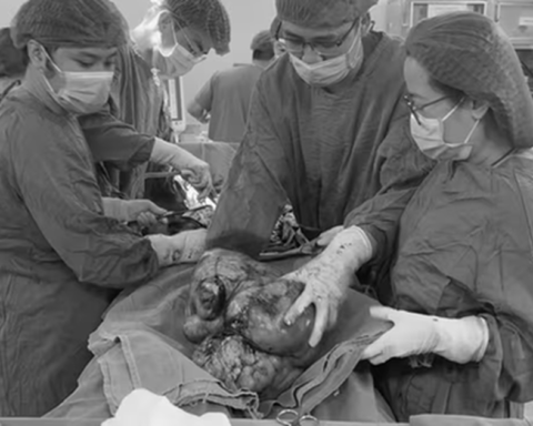 Đau âm ỉ vùng bụng suốt, người phụ nữ sốc khi bác sĩ lấy ra thứ “đáng sợ” trong cơ thể mình