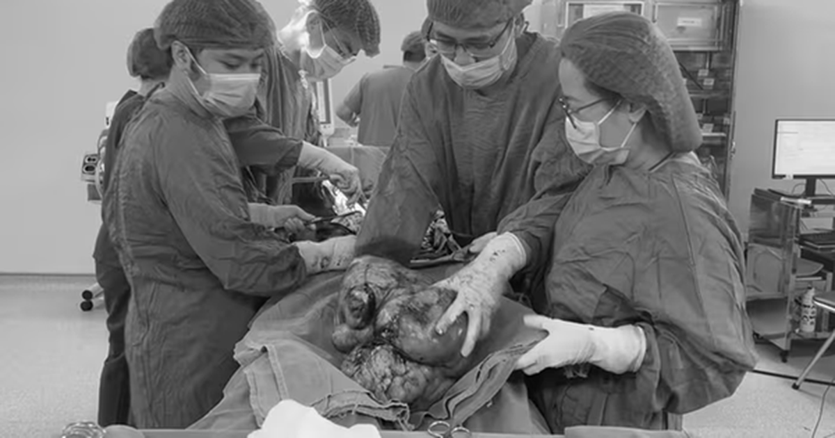 Đau âm ỉ vùng bụng suốt, người phụ nữ sốc khi bác sĩ lấy ra thứ “đáng sợ” trong cơ thể mình