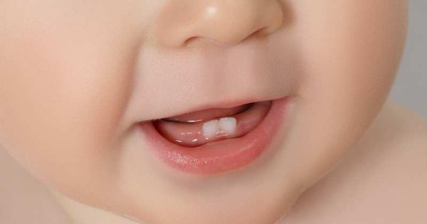 Trẻ chậm mọc răng: Nguyên nhân và dấu hiệu cần lưu ý