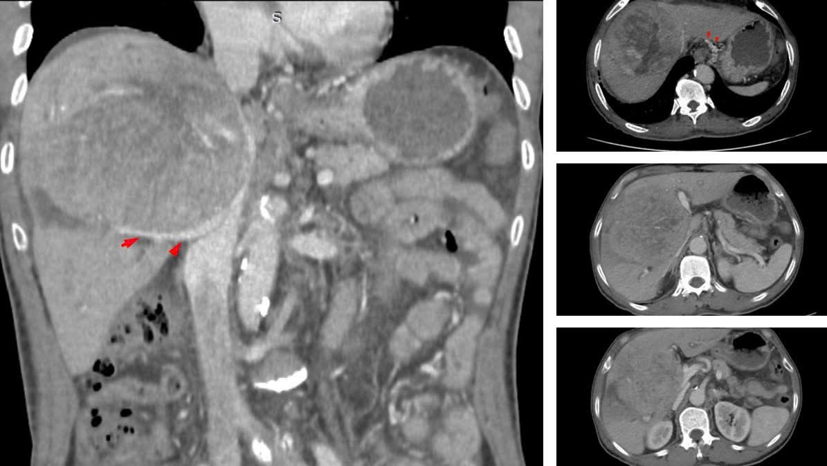 Mắc ung thư gan, được tiên lượng chỉ sống thêm vài tháng, người đàn ông Hà Nội làm được điều khó tin- Ảnh 1.