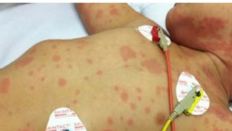 Đau bụng kéo dài, đi khám mới biết mắc cùng lúc 2 khối ung thư - Ảnh 2.
